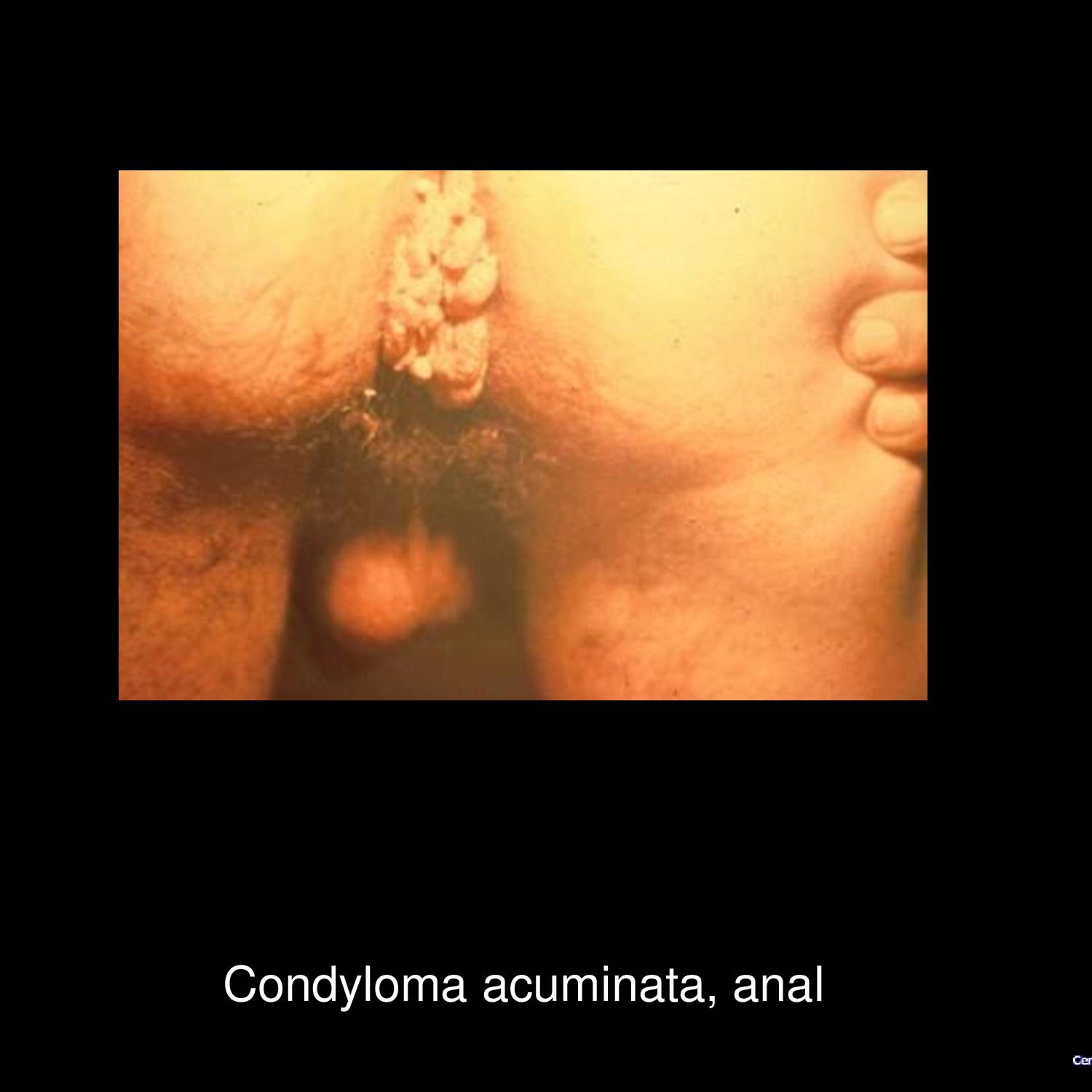 Perianal condyloma acuminata showing extensive cauliflower-like wart lesions around anal orifice caused by HPV types 6 and 11